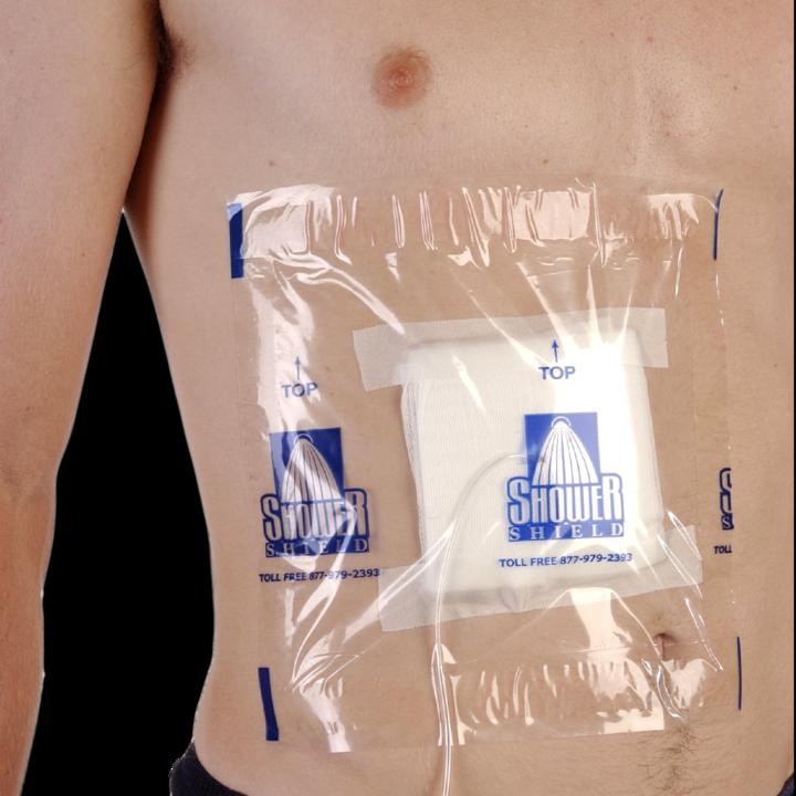 What to Expect After an Ostomy